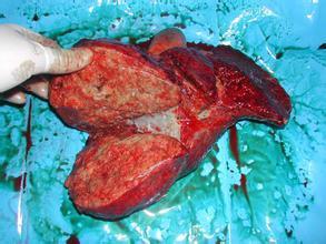 肝癌首发症状以肝区疼痛最为常见,其次是上腹部包块.