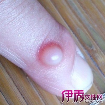 【图】手指头上起的小水泡图片大全 5个方法轻松去小水泡