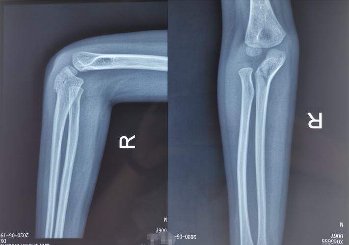 病例1 3型孟氏骨折,拟闭合复位克氏针固定.