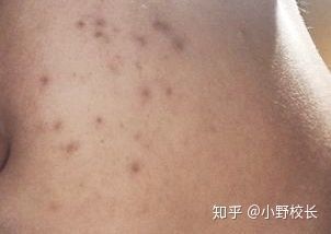 一般在痘印后期,是炎症痘痘后的色素沉淀,褐色的比较常见.