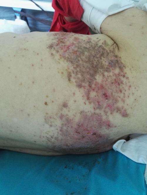 八十岁老人带状疱疹好转出院