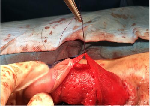 讲解:阴茎延长 增粗手术