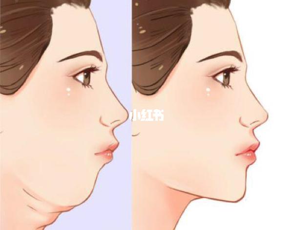 面吸双下巴|永远完美下颌线_双下巴_下颌线_深圳自由行热门攻略_吸脂
