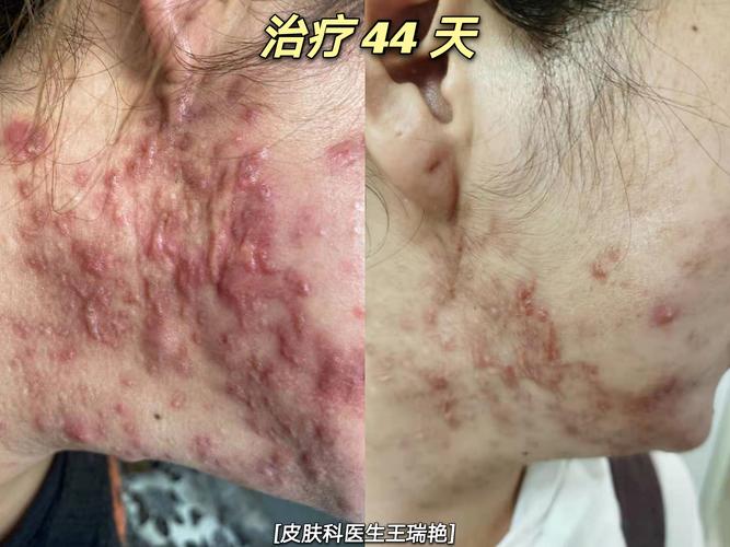下颌角痤疮增生性瘢痕治疗前后