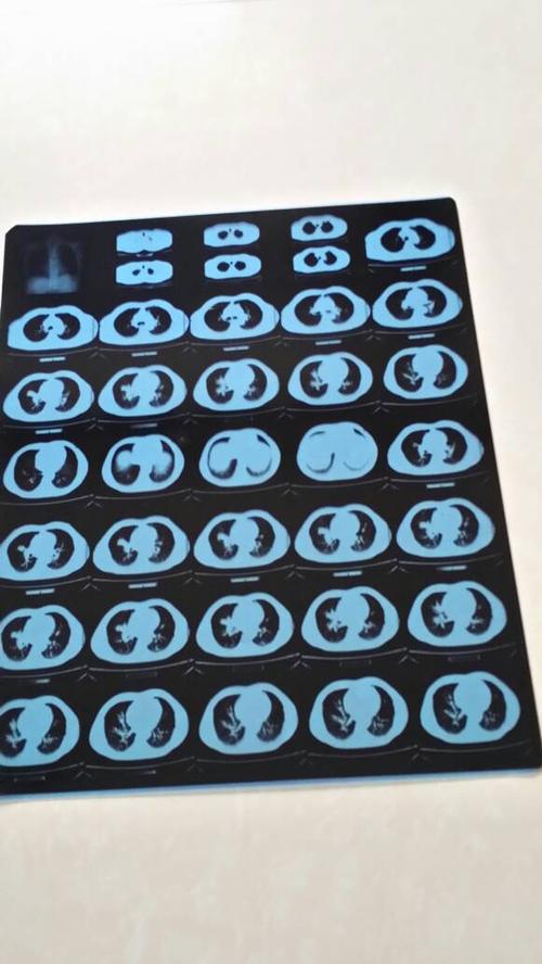 肺部ct片怎么看?