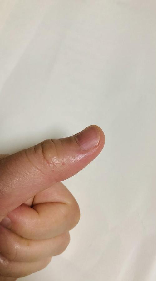 我的汗疱疹治疗史