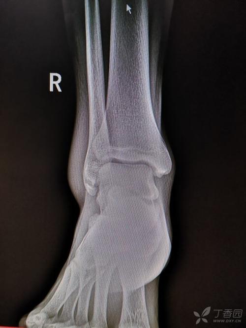 患者,男,17岁,扭伤致右踝关节肿痛活动受限3天.dr及ct如下