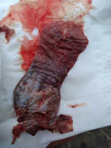 来月经第二天阴道掉出来一大块像皮一样的东西