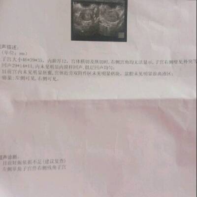 2,hcg143.11号b超,未见胚囊,左侧单角右侧残角子宫.