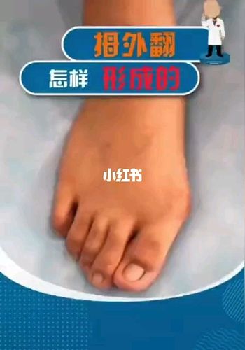 视频有详细讲解喔!_拇外翻_知识