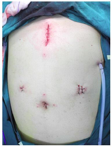 非气腹腹腔镜辅助经膈食管癌切除术疗效有待证实