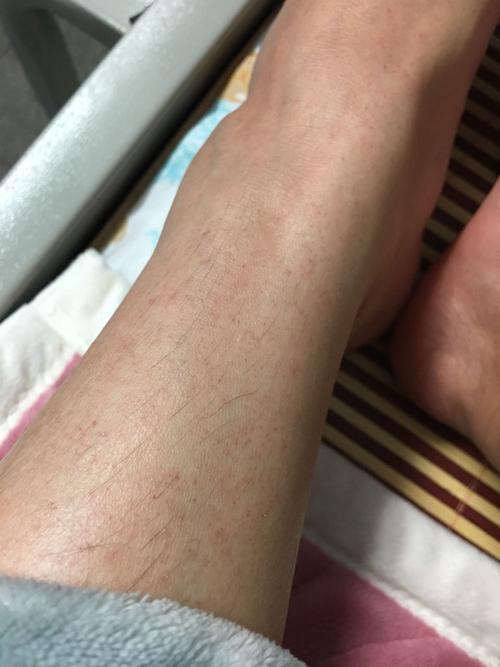 两边小腿都长小红点,不痛不痒不凸起,这是为啥?