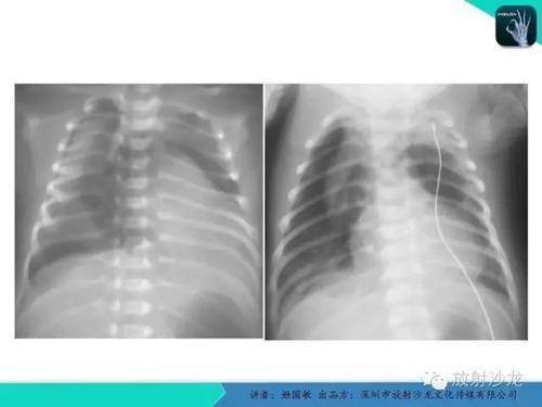 新生儿呼吸困难肺部x线诊断