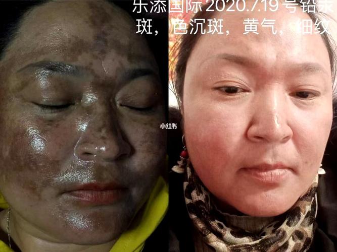 铅汞斑_护肤_美妆_护肤_护肤其他