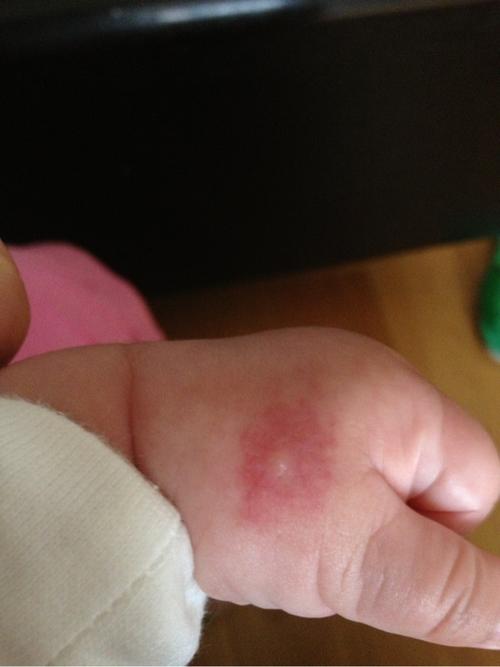 宝宝被小虫子咬了