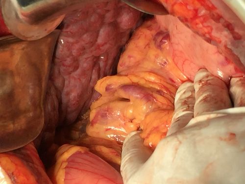 消化道大出血,食道胃底静脉曲张,脾切断流术后.