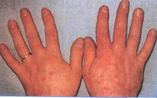 生殖器疱疹症状常见的表现为阴部出现一堆约3-4个至5-6个小水疱,基底