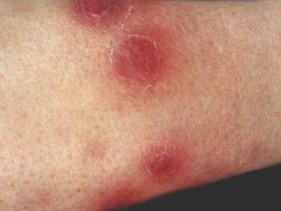 硬红斑有结核样浸润,常发生干酪样坏死,一直被人认为是一种皮肤结核病