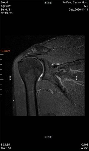 肩关节矢状位mri:提示冈上肌腱连续性存在,前下盂唇损伤,前下关节囊