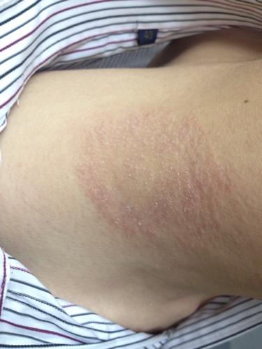 请问这种是什么皮肤病,会传染吗