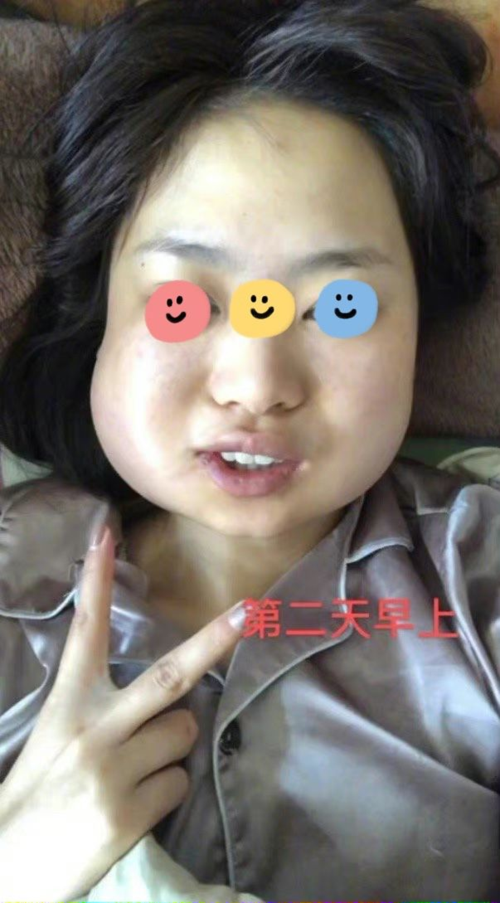 一次性拔完全部智齿后,你的脸部会发生什么变化?