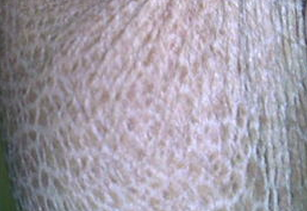 而鱼鳞病,据现代医学研究是这种鱼鳞病一般是先天性的,而且病症的表现