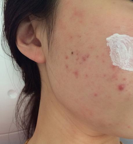 问:脸上这痘痘怎么办,动不动就搽药那地方过敏,有什么好的治疗方法么?