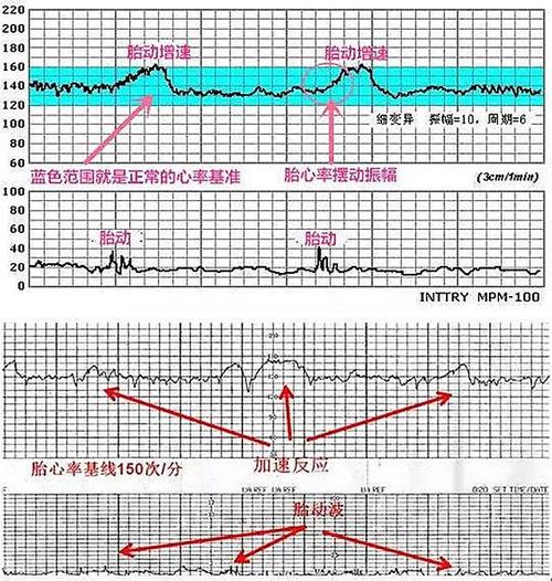 临产前胎心监护越发频繁,是否必要?胎监顺利通过,在于