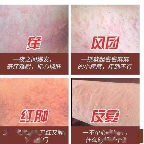 神经性皮炎症状表现