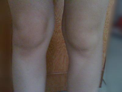 膝盖骨头突出怎么办啊?