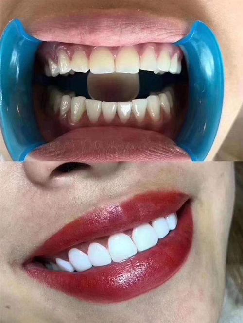 零基础学习美牙去哪学习比较好哪家专业正规国内排名前十大美牙贴面