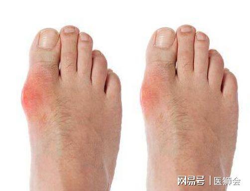 双能ct是明确关节部位是否存在"痛风结晶"的快速,无创,直观且 最有效