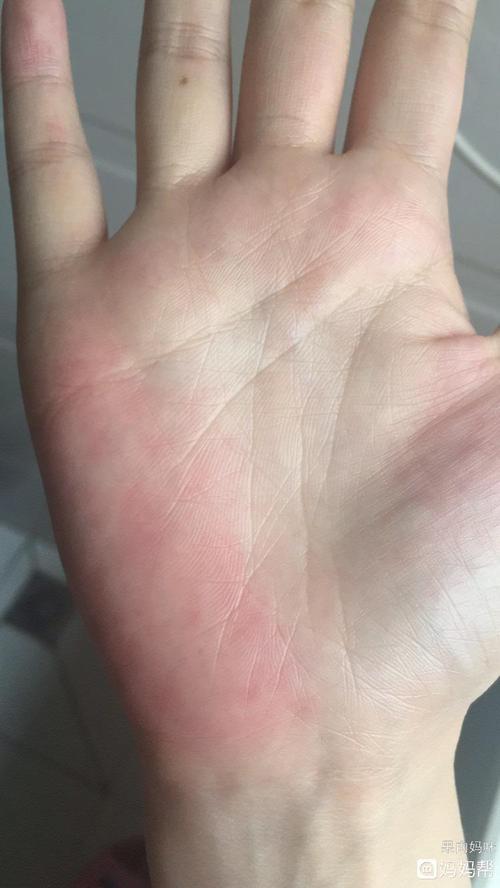 生完宝宝后,双手的小鱼际发红是怎么回事?