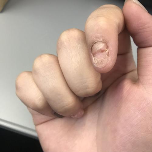 食指左边刚长出来的指甲和肉的地方很疼 好像指甲的肉挡住指甲的生长