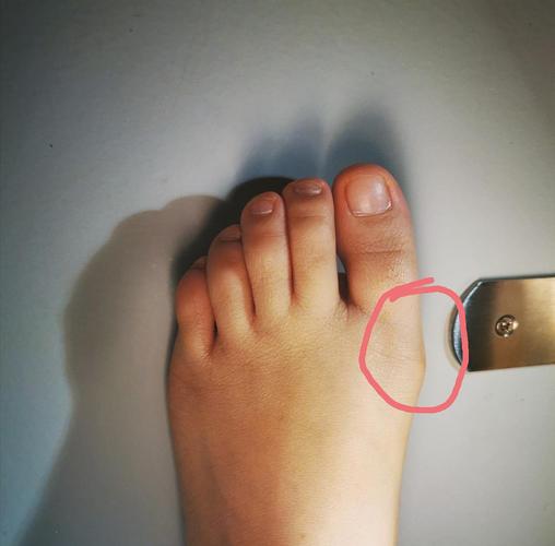 姐妹们,我这属于拇指外翻还是腱鞘炎?