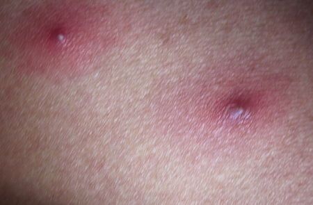 腹部长了两颗疮(有图),大家看是什么原因?