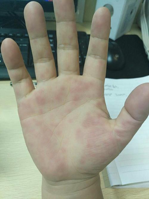手心有红点又痒又痛是什么回事,该吃什么药啊?在线急等!