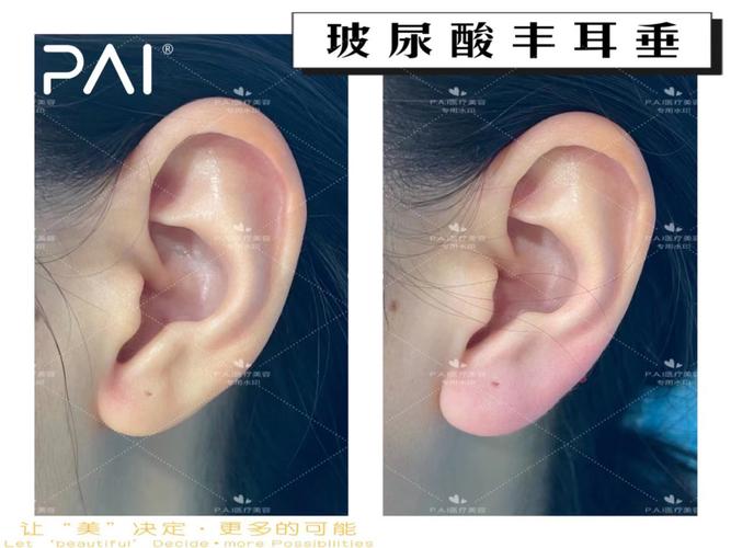 玻尿酸丰耳垂_玻尿酸_美妆_医美整形