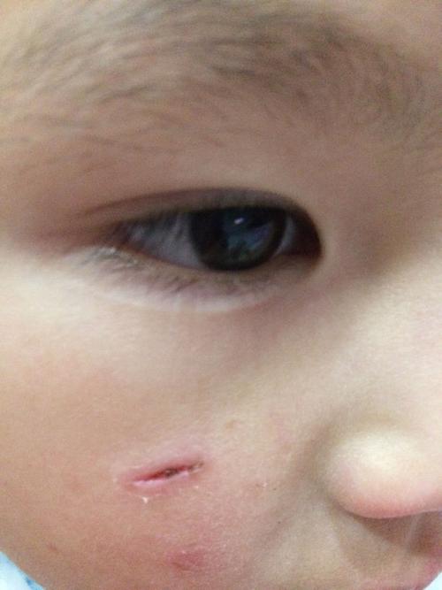 宝贝脸上被不小心划破了,会不会留下疤痕?应该擦什么么?