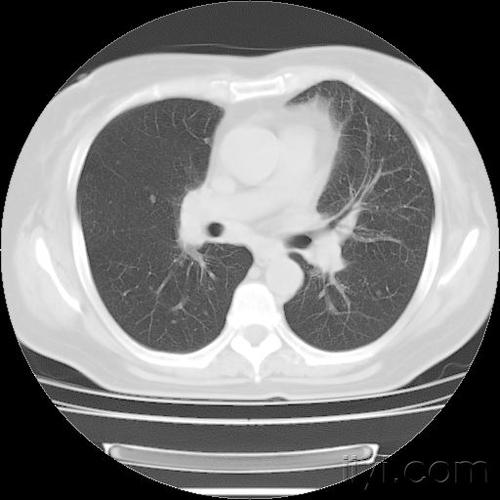 半年前检查身体时,胸透未见异常.