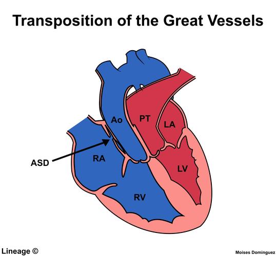 a congenital heart defect in which the aorta leaves the right
