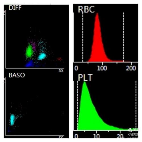 血常规病例之异常细胞虽然少,一样不能放跑了
