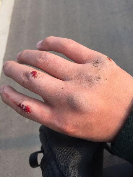 我用拳头打树上打了十拳不到 骨头或者筋会受伤吗