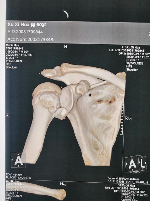 该患者行ct检查提示肩关节后脱位合并反bankart损伤 反hill-sachs