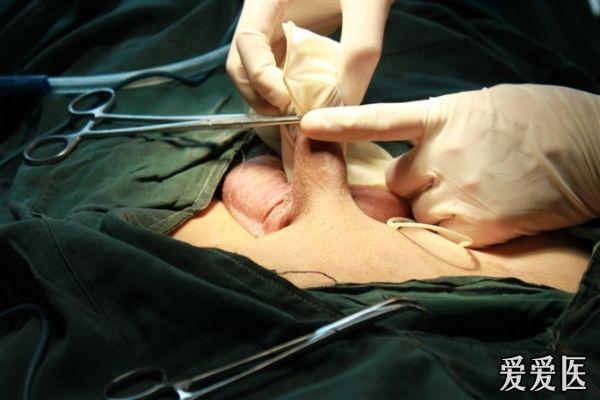 阴茎癌部分切除全过程