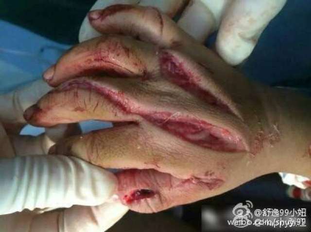 五岁孩子被继母砍了三十多刀.图片血腥,不忍直视