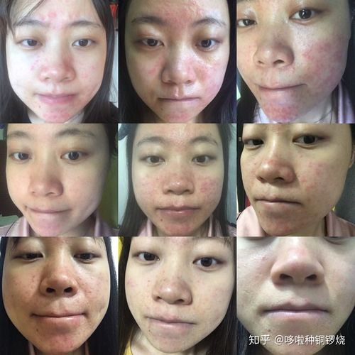 面部脂溢性皮炎很多年了,特别难过,请问我该怎么办?