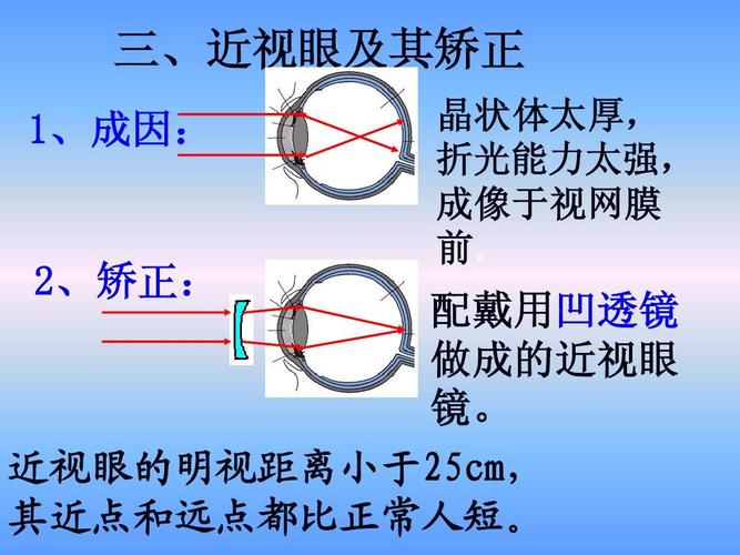 三,近视眼及其矫正 1,成因: 晶状体太厚, 折光能力太强, 成像于视网膜