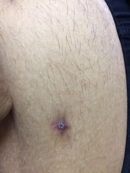 9月13阑尾炎微创手术出院的到现在10月19号了 有懂的请看看我这个伤口