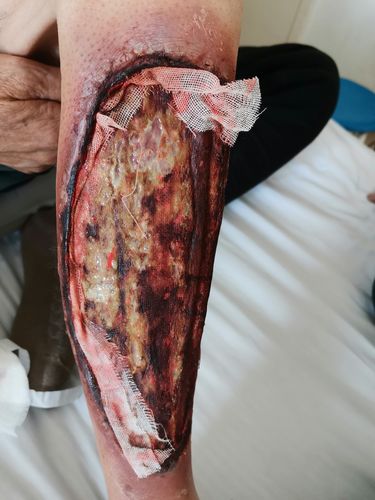 下肢动脉硬化健康的隐形杀手